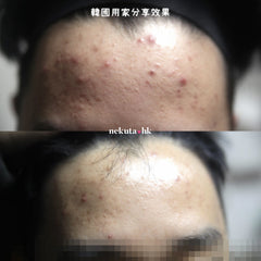Clearteen Topical Acne Treatment 30ml